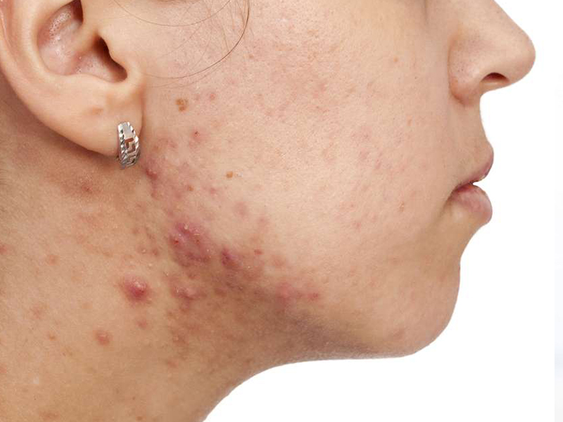 Ayurvedic Skin Disease Treatment Psoriasis Eczema Prakriti Chennai